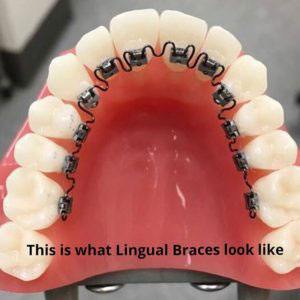 Lingual Braces (INBRACE) | Dentist In Whittier, CA