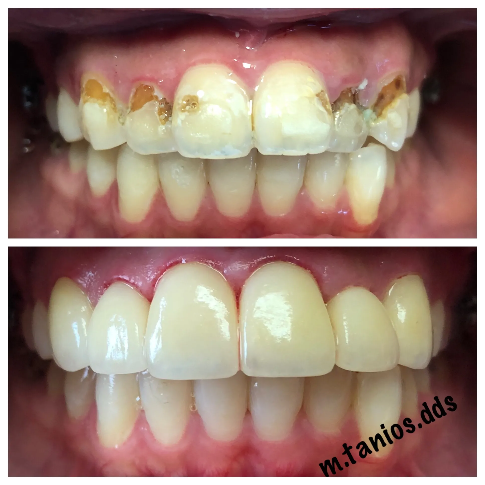 2 pictures depicting before and after crowns