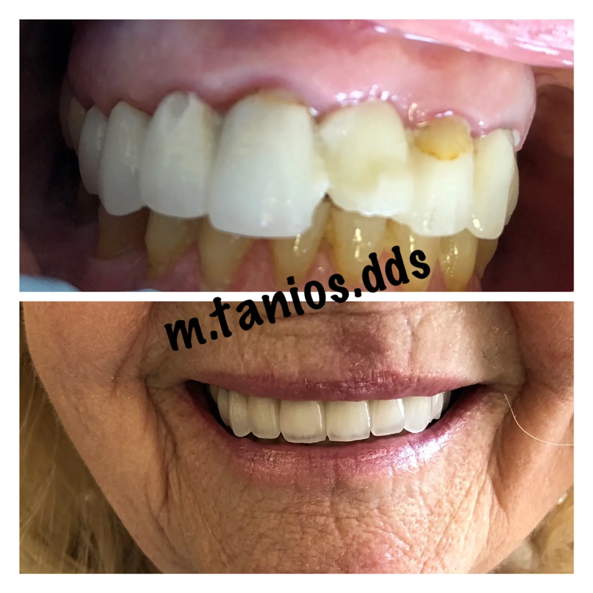 2 pictures showing before and after crowns