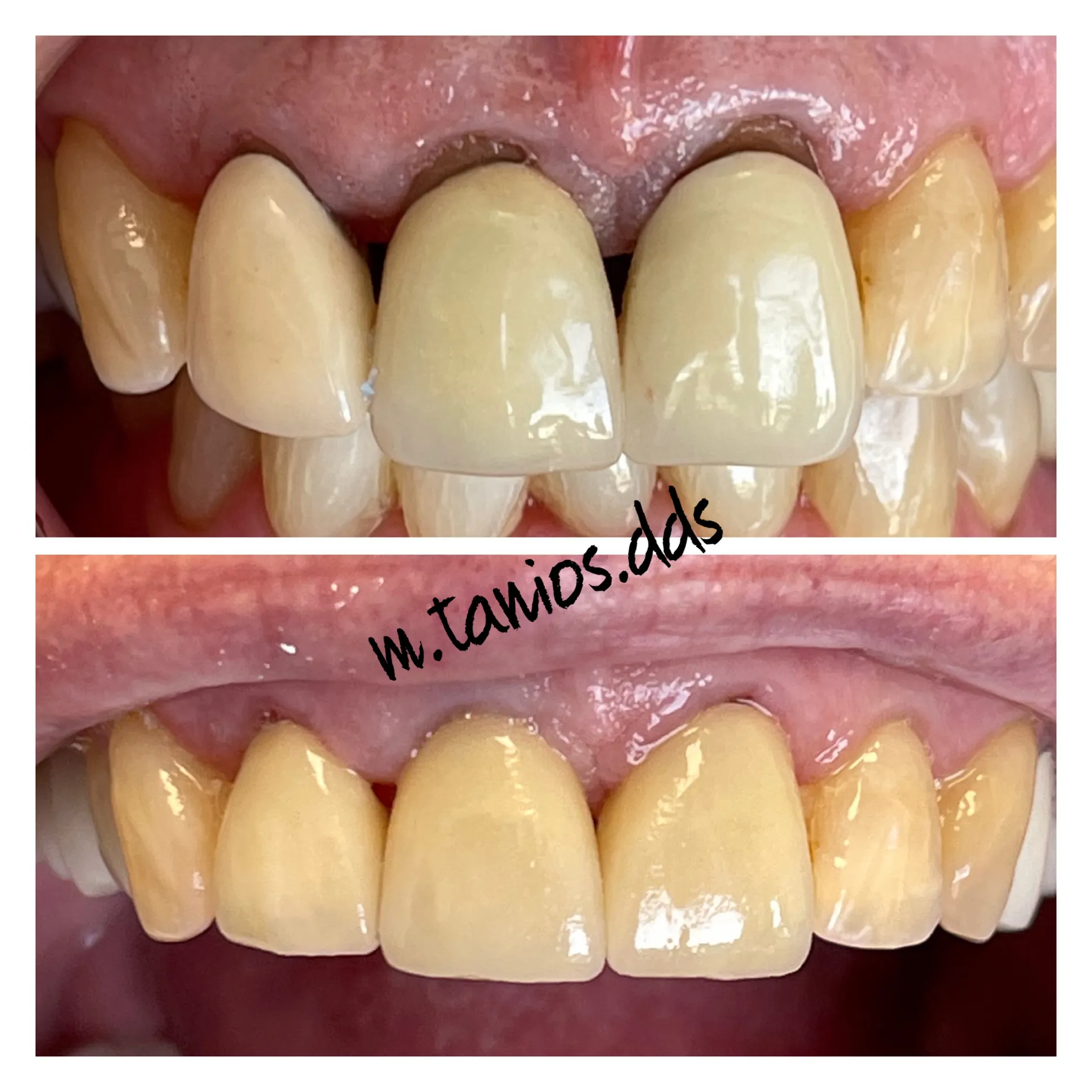 2 photos before and after crowns