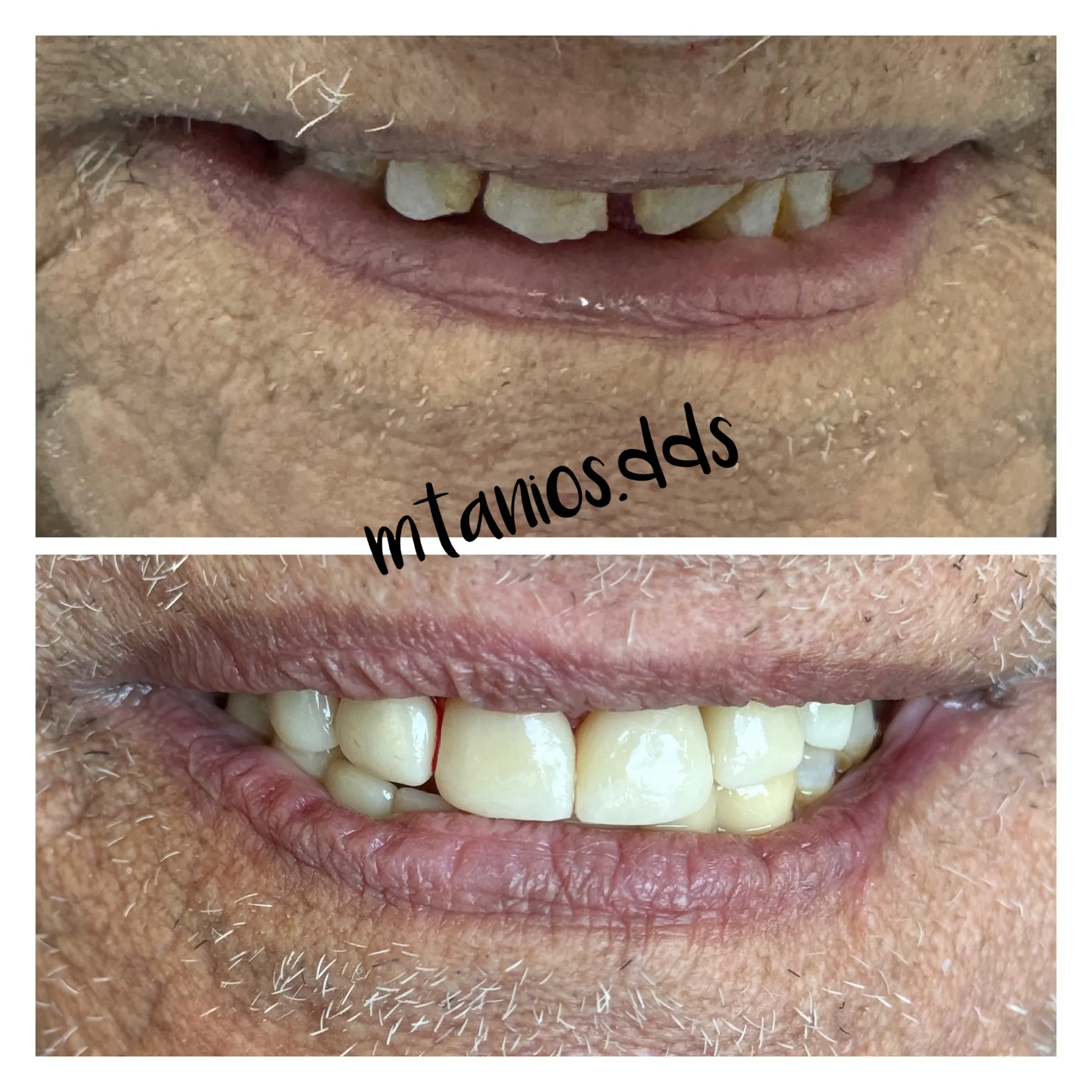 2 pictures of before and after crowns