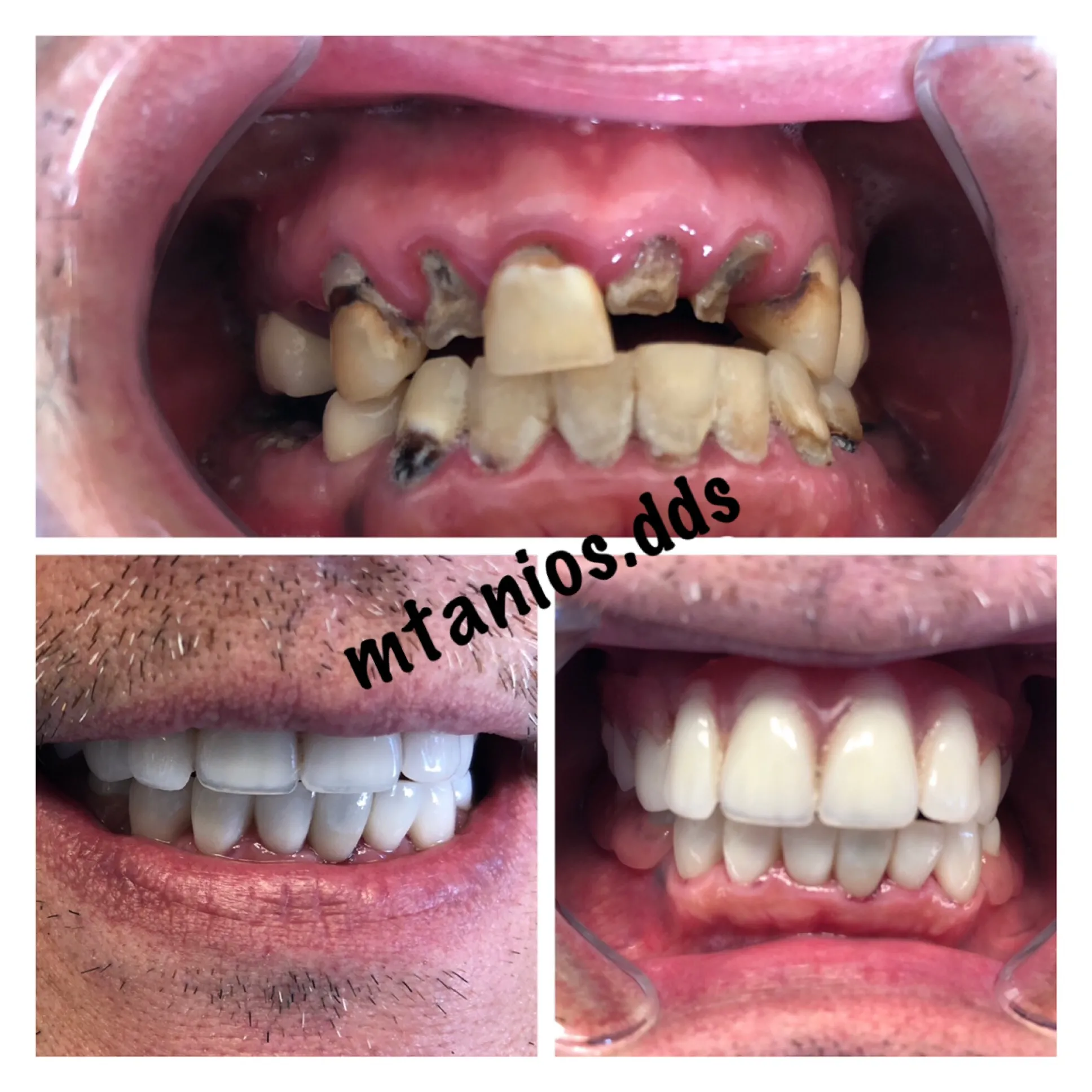 3 pictures displaying before and after dentures