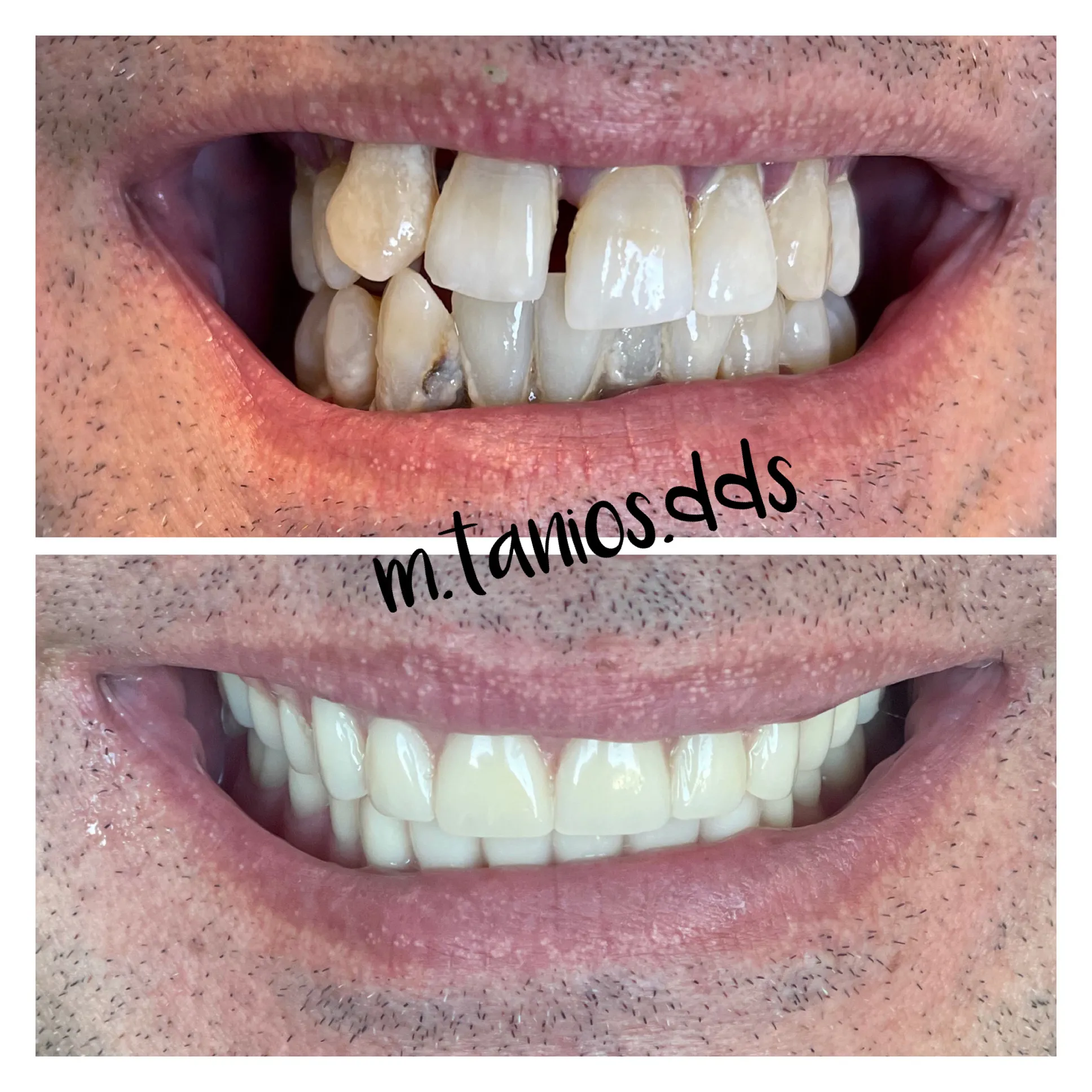 2 pictures of before and after dentures