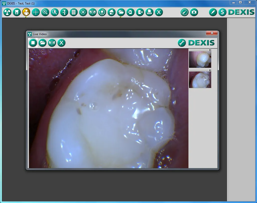 Intraoral camera looking at a tooth