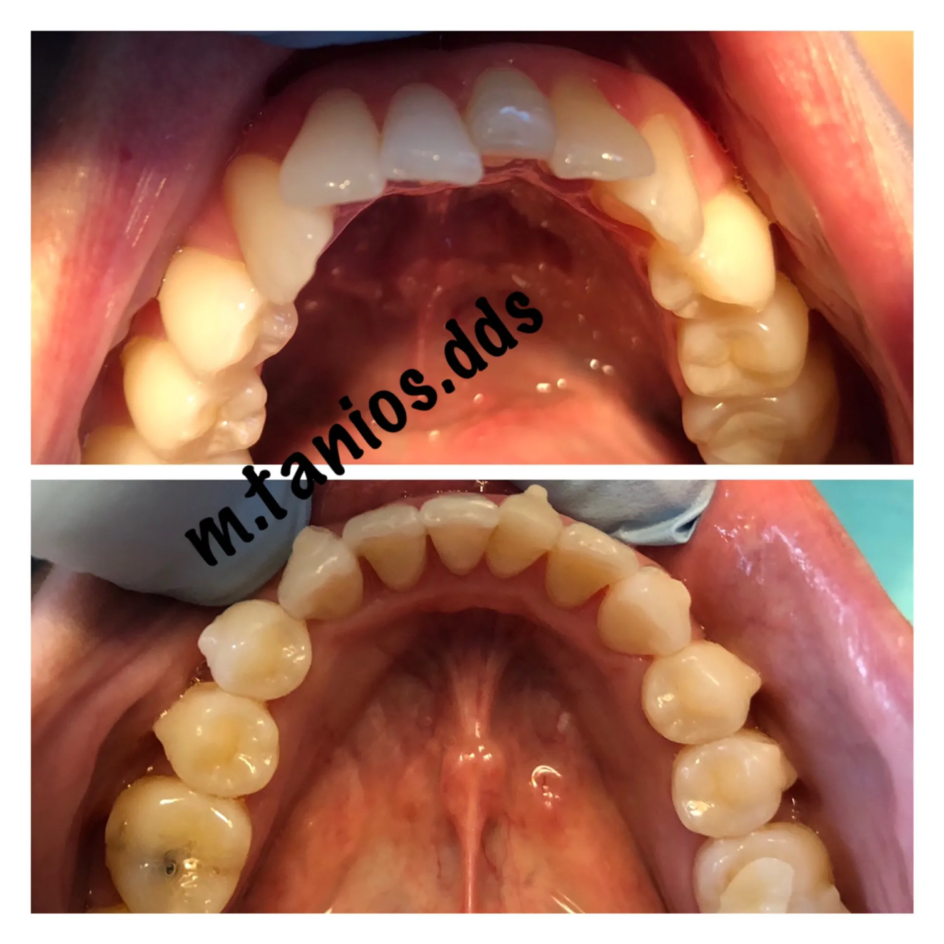 2 photos showing open mouth before and after invisalign