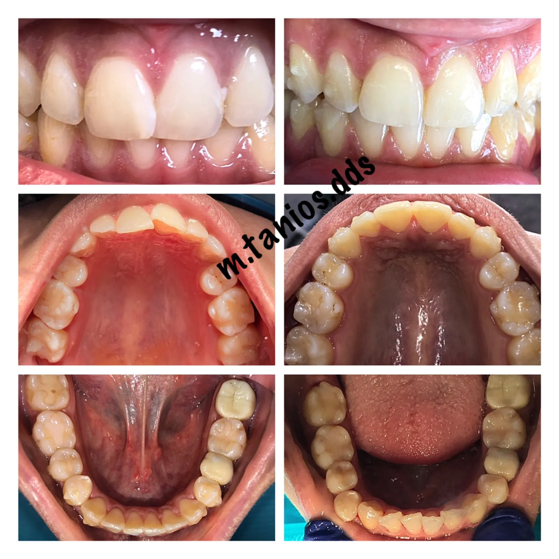 6 photos showing before and after invisalign