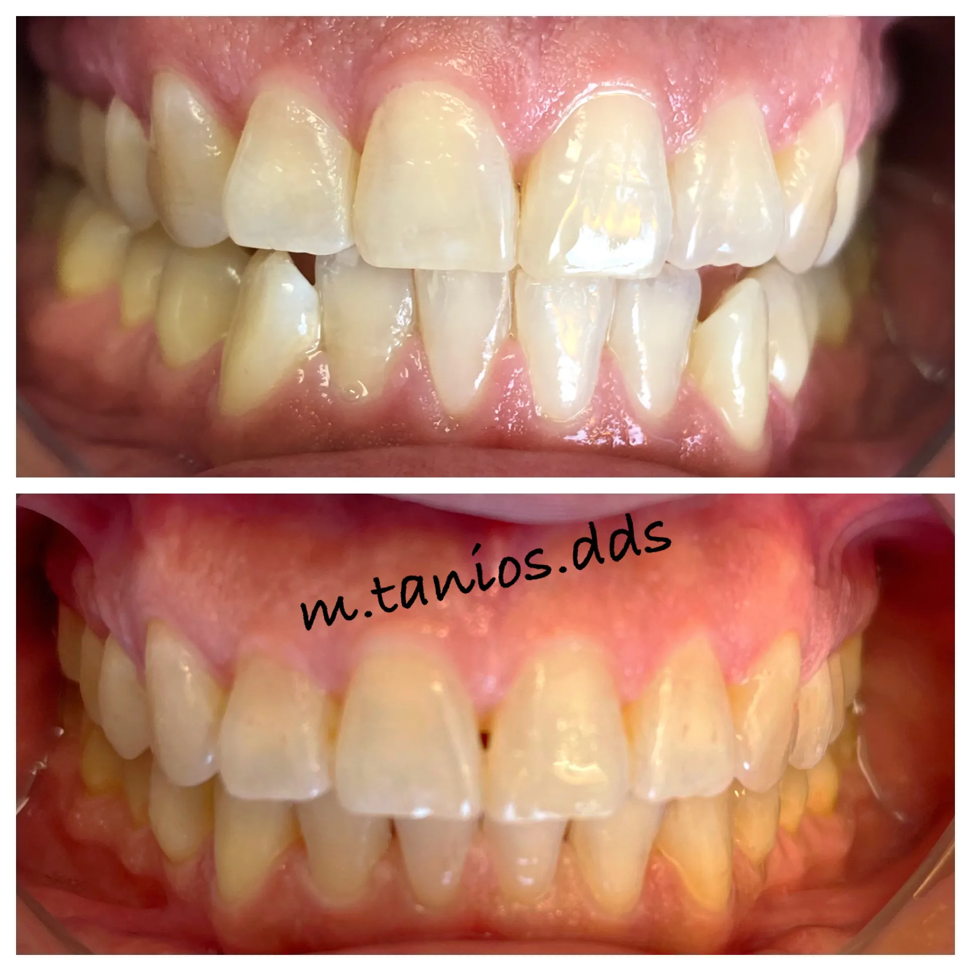 2 photos of closed mouth before and after invisalign