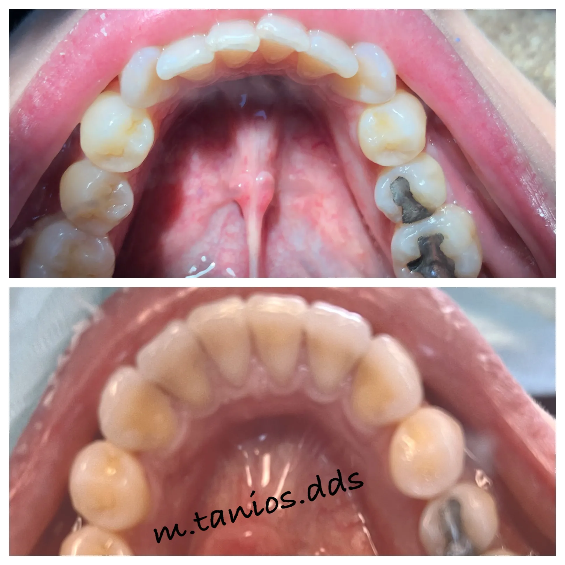 2 photos of open mouth before and after invisalign