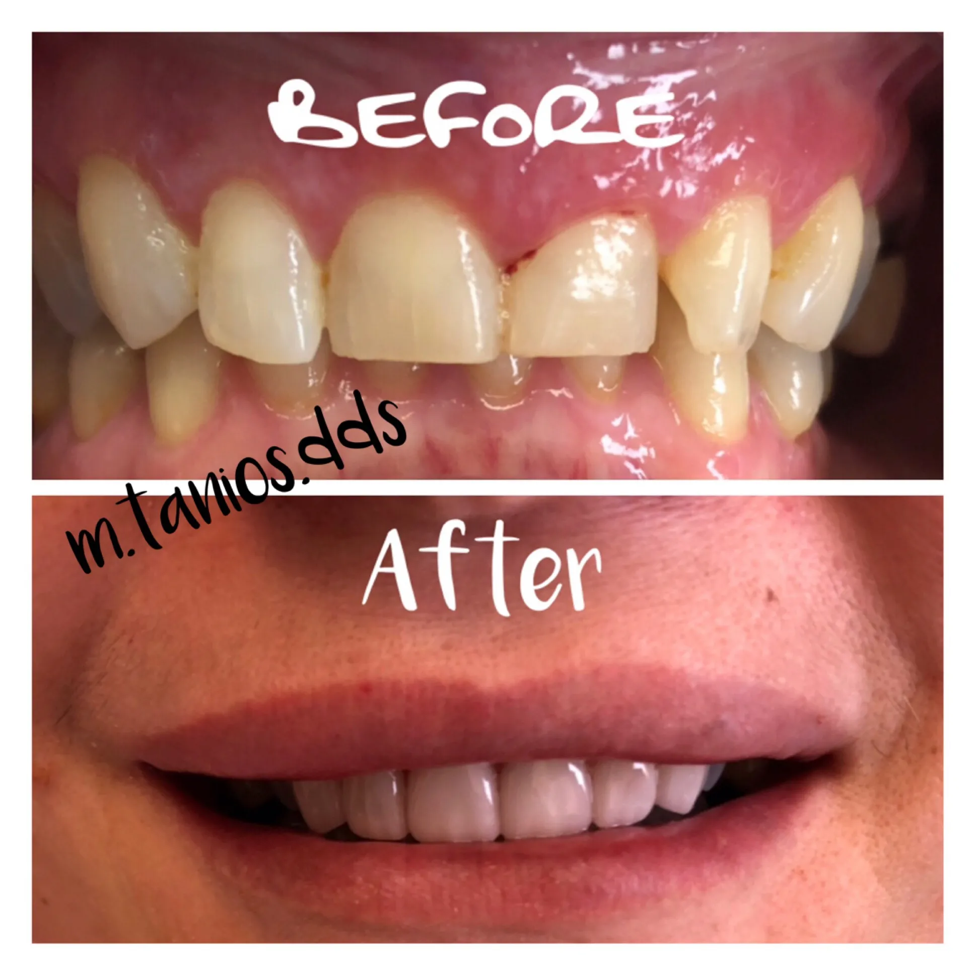 2 pictures with text before and after veneers