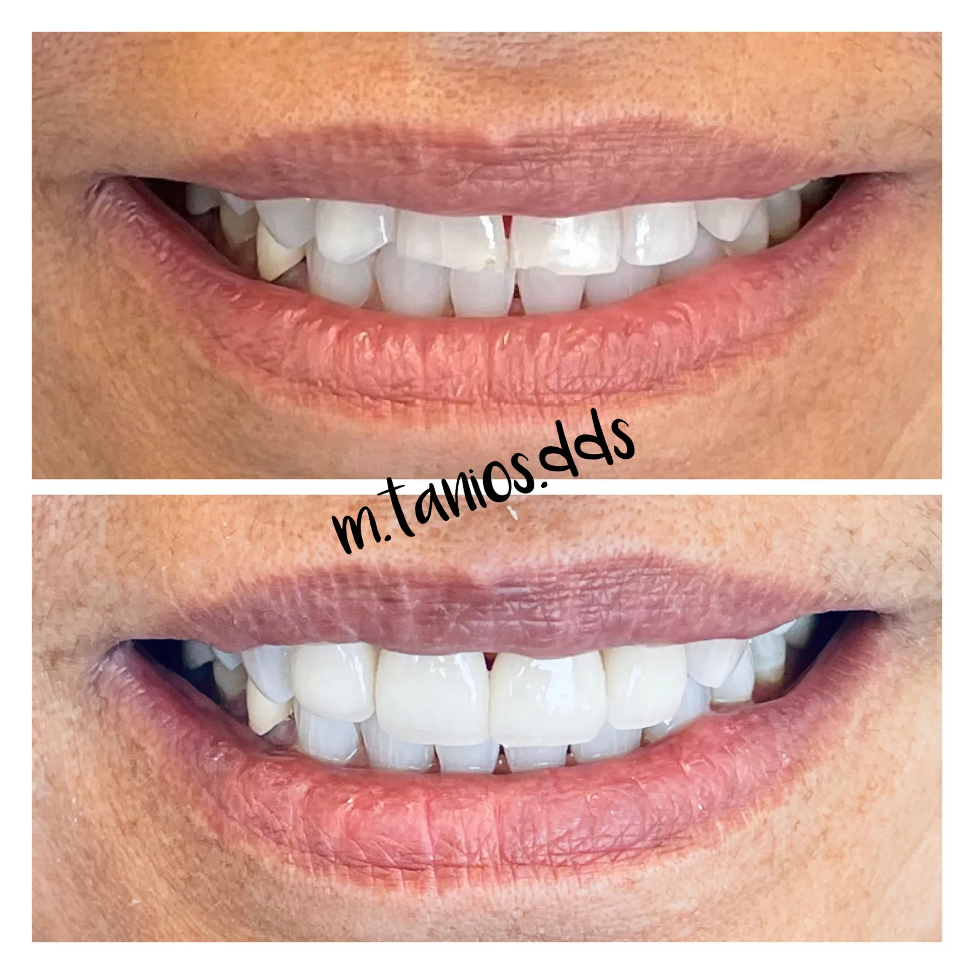 2 pictures before and after veneers